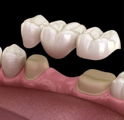 Crowns & Bridges — Illustration: a porcelain bridge replacing missing teeth. Not a photo of a patient.